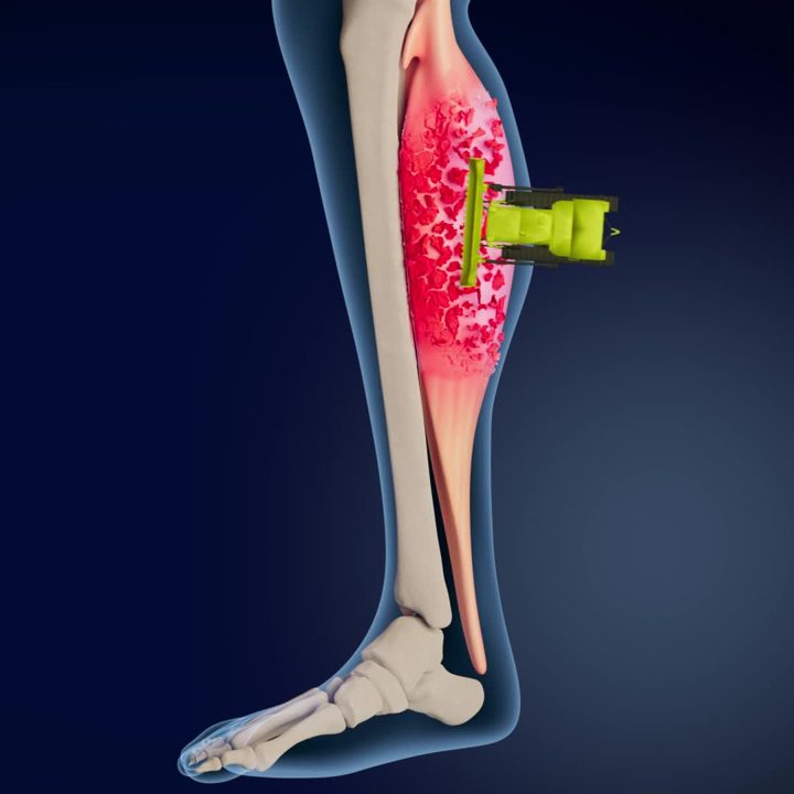 MagCombo ad. Angle: Disease imagery: magnesium to the rescue