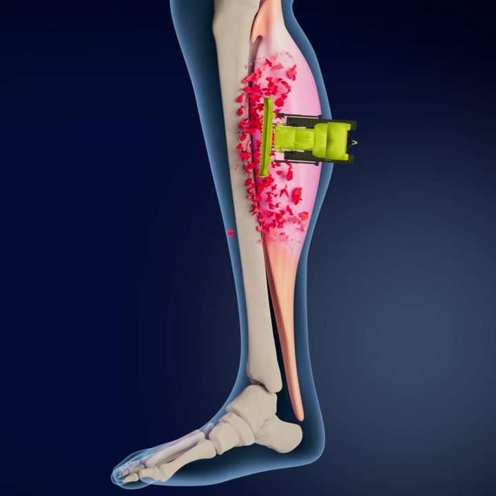 MagCombo ad. Angle: Fast-acting magnesium, shown working on the muscle